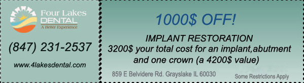 implant-restoration