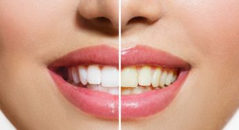 Grayslake IL Dentist | Stained Teeth